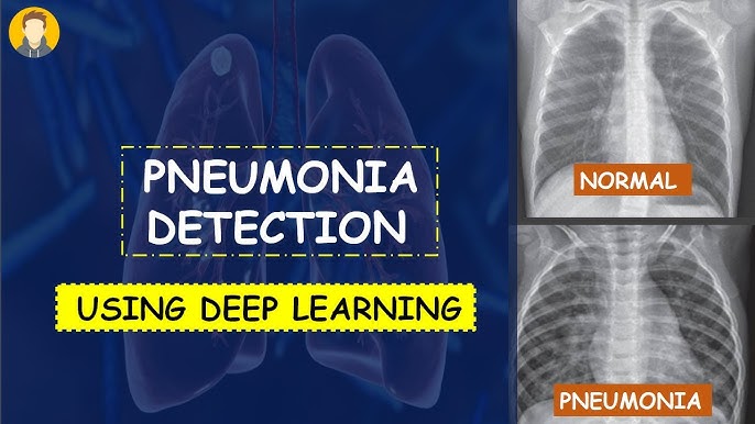 Pneumonia Detection using Deep Learning and Computer Vision
